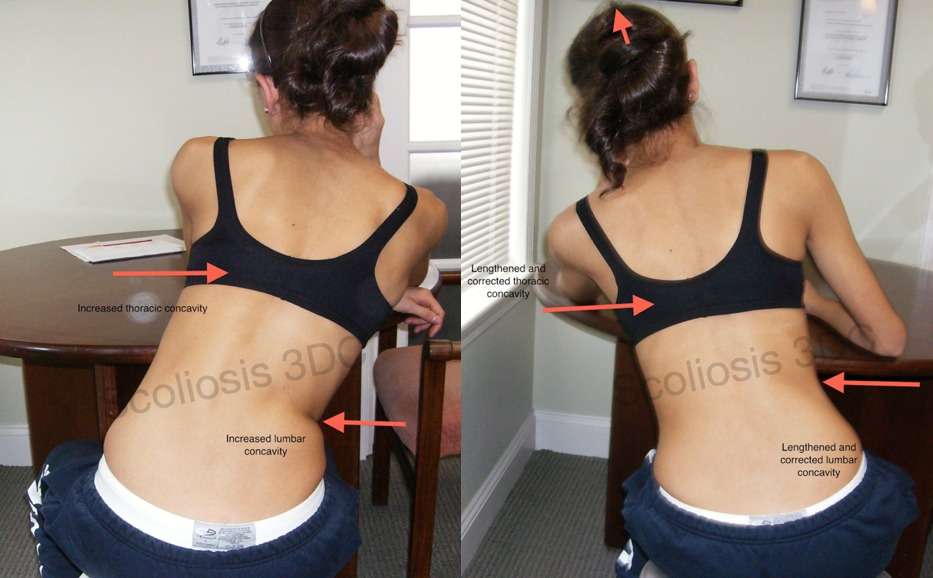 Schroth Best Practice scoliosis treatment, scoliosis exercises, scoliosis posture