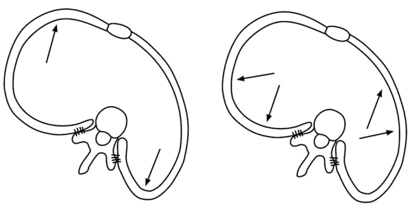 scoliosis breathing, rotational breathing, schroth breathing