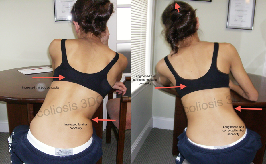 photo showing how to fix scoliosis posture