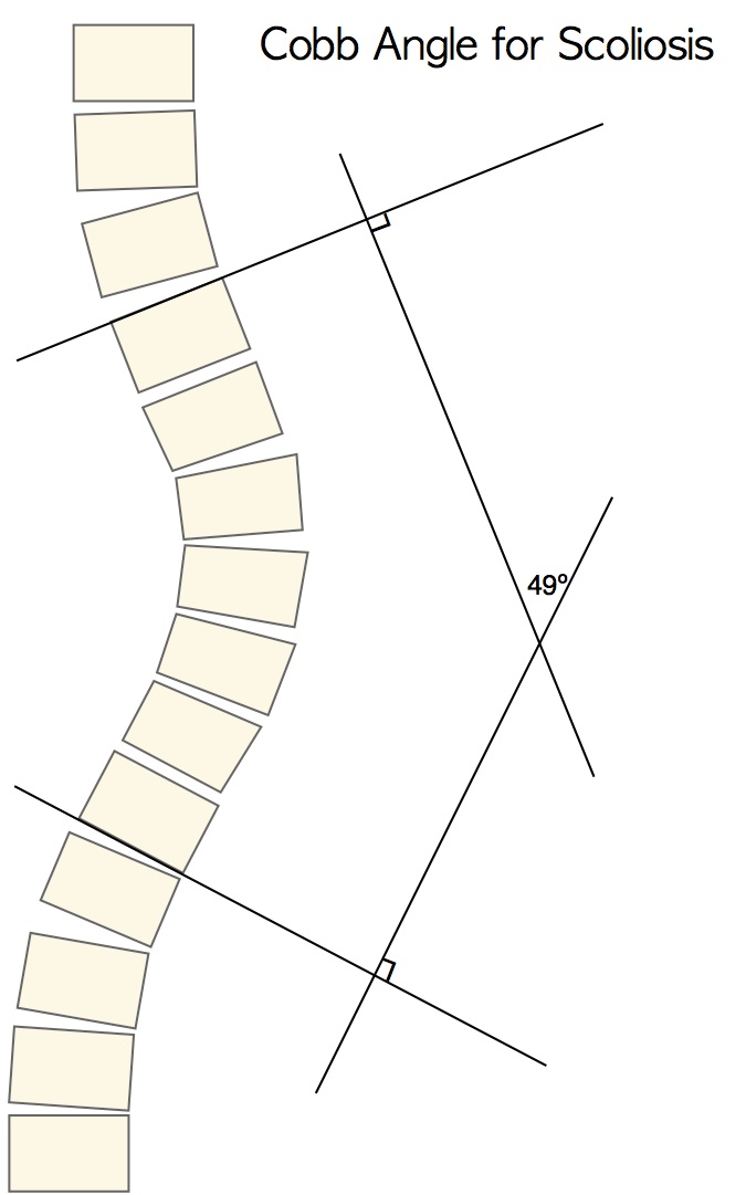 Cobb angle measurement