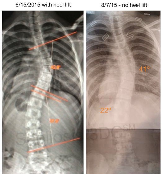 heel lift for scoliosis