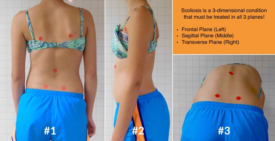 Three dimensions of scoliosis, 3D treatment of scoliosis