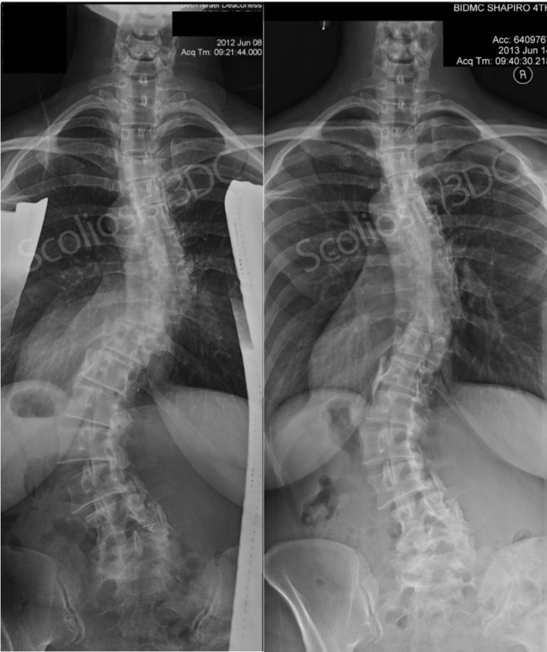 adult reduces scoliosis, can you improve scoliosis as an adult