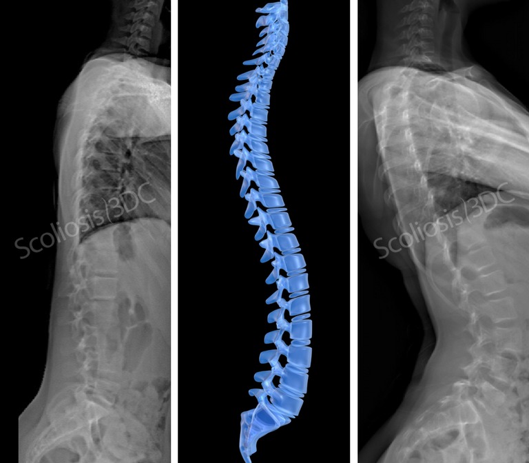 sagittal plane of scoliosis