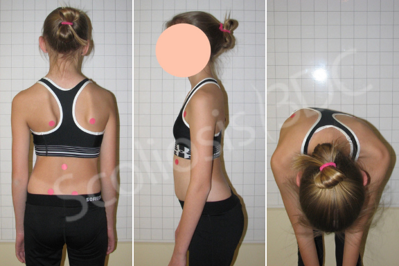 example of idiopathic scoliosis