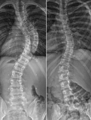 idiopathic scoliosis xrays