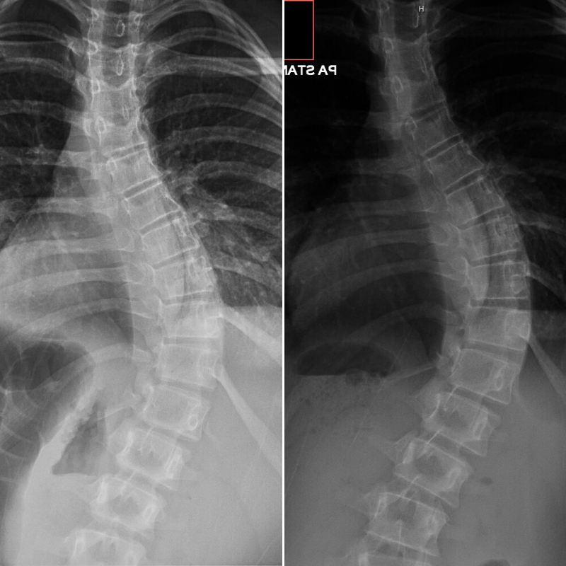 example of progressive scoliosis