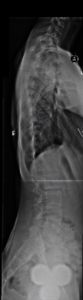 sagittal plane flattening in scoliosis