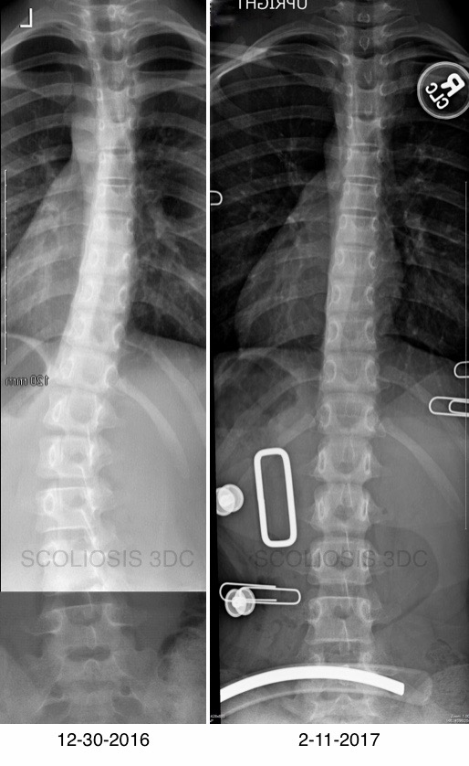 Thoracolumbar Scoliosis Scoliosis Of The Mid Spine