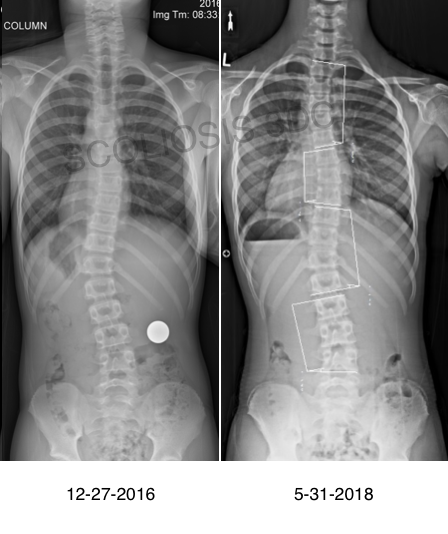 risser-0-what-is-risser-0-risser-0-scoliosis-treatment