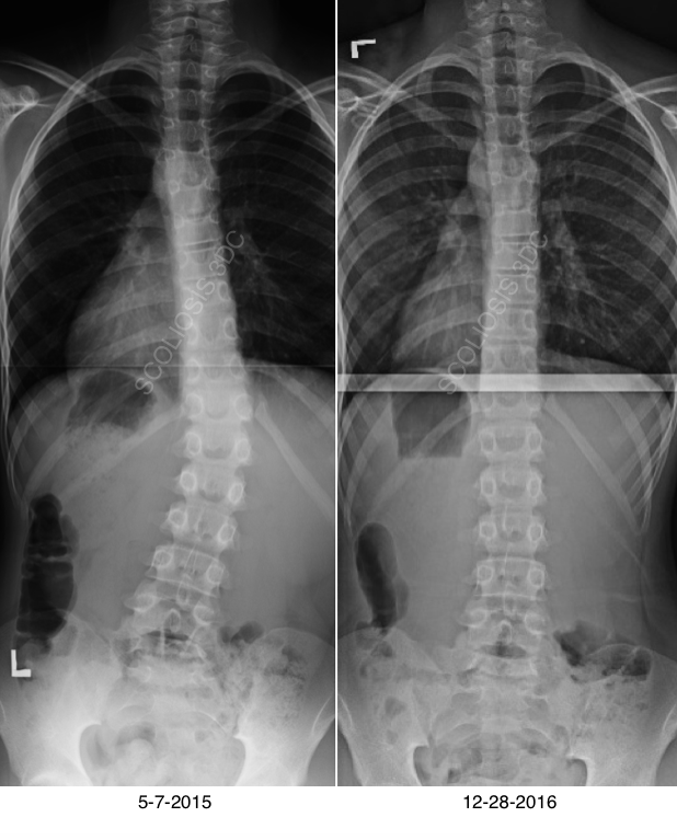 Risser 0 | What is Risser 0 | Risser 0 Scoliosis Treatment