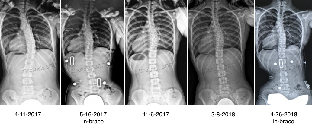 Risser 2 What Is Risser 2 Risser 2 Scoliosis Treatment