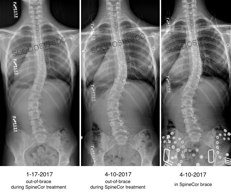 Risser 3 | What is Risser 3 | Risser 3 Scoliosis Treatment