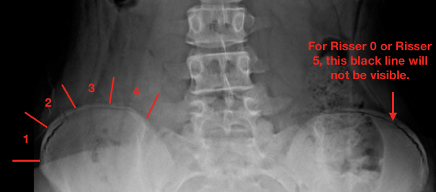 Risser Sign | What is Risser Sign | Risser Sign Scoliosis